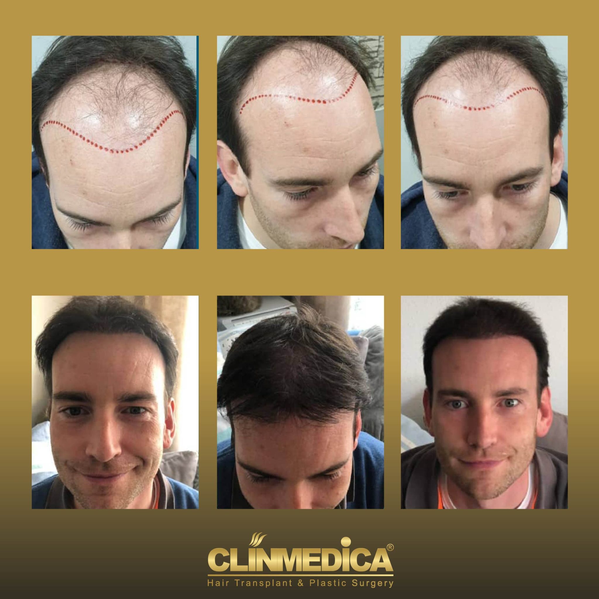 hair transplant before and after in Turkey