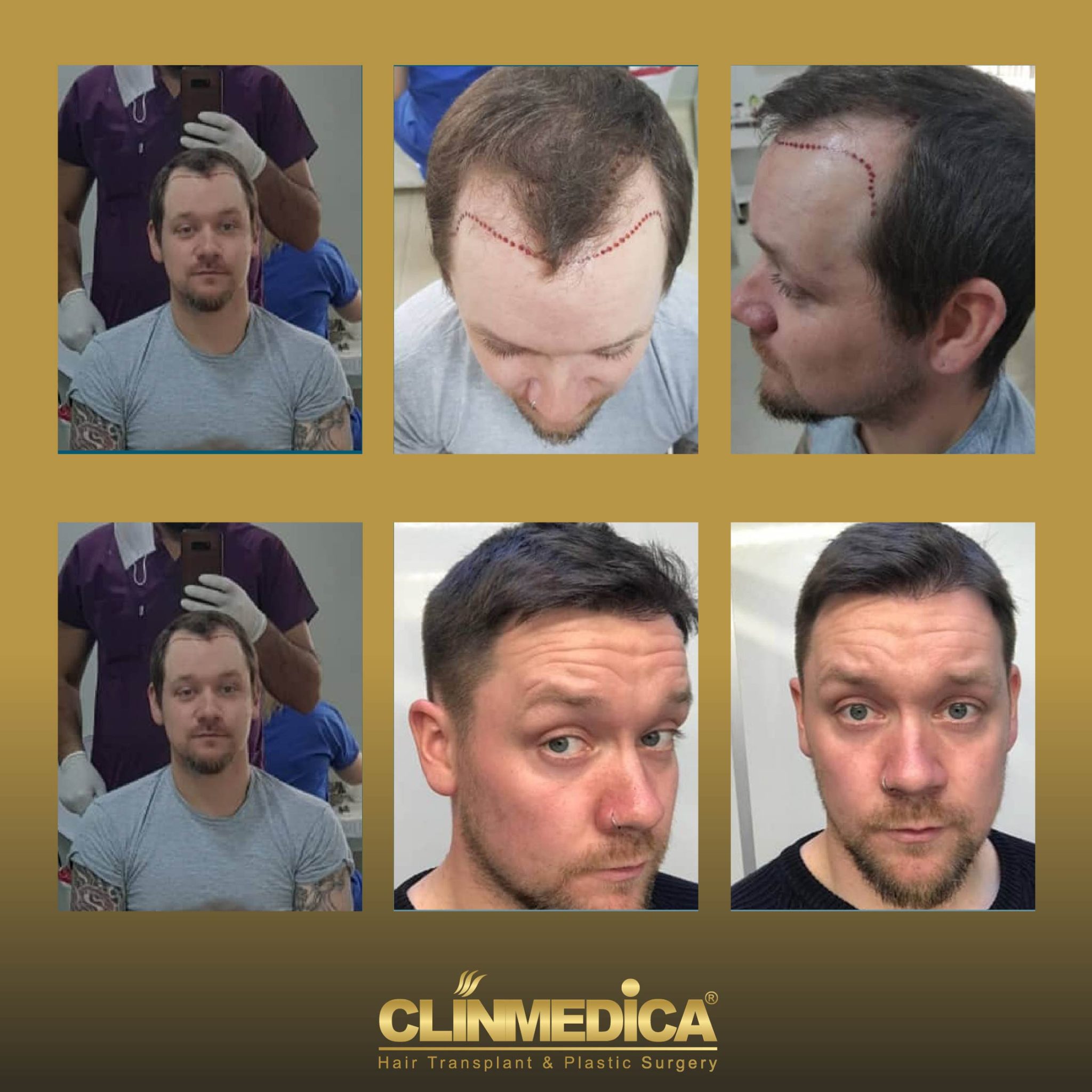 hair transplant before and after in Turkey