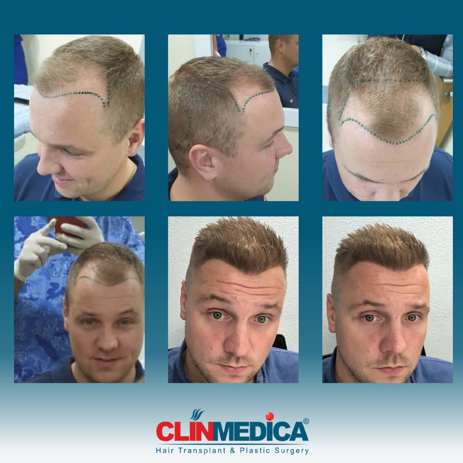 Hair_Transplant_Turkey_before_After_Clinmedica