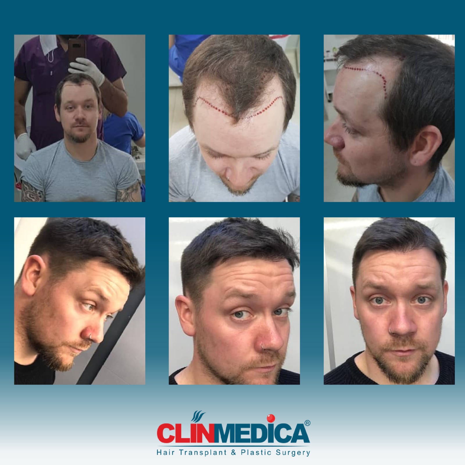 Hair_Transplant_Turkey_before_After_Clinmedica
