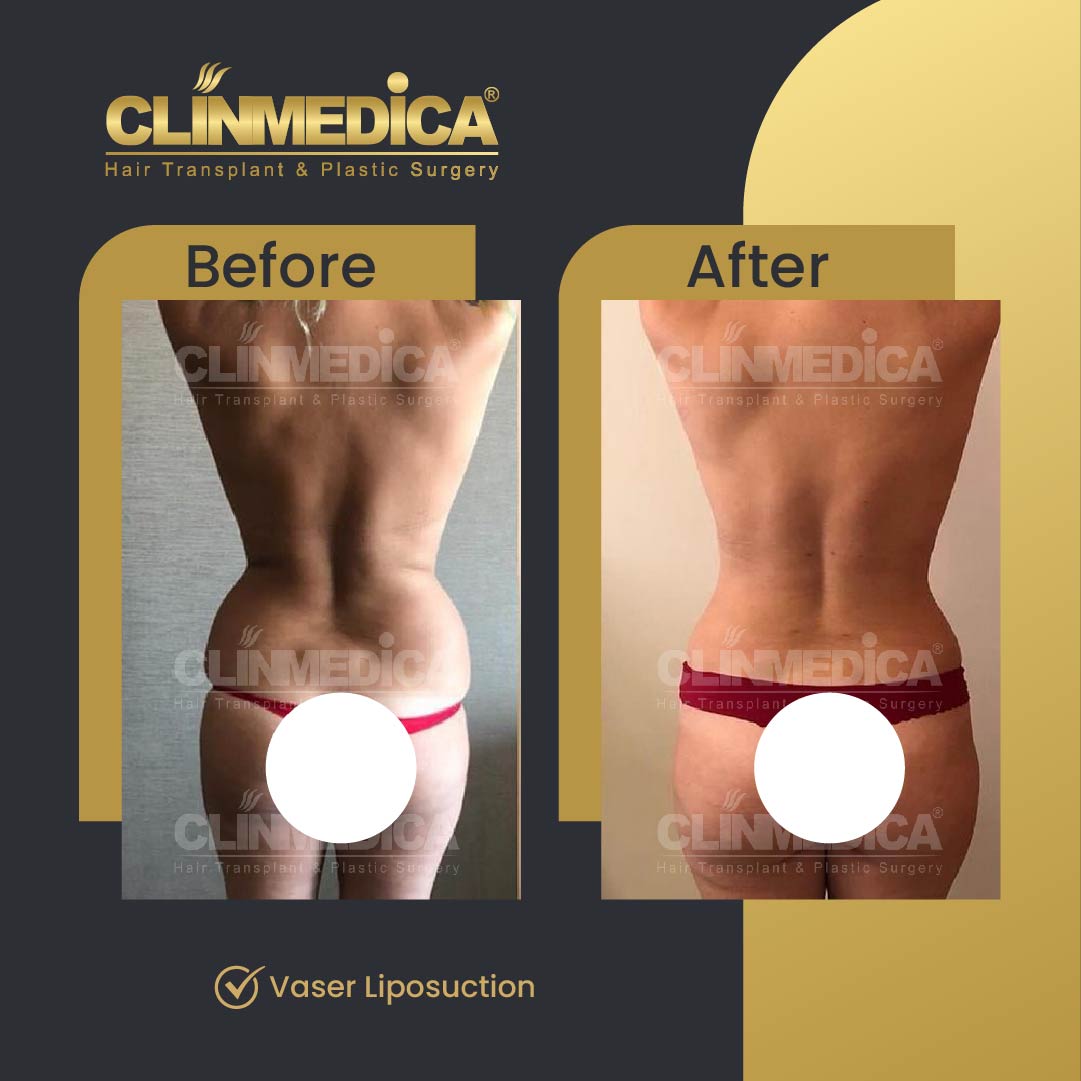 Liposuction surgery in Turkey - before and after