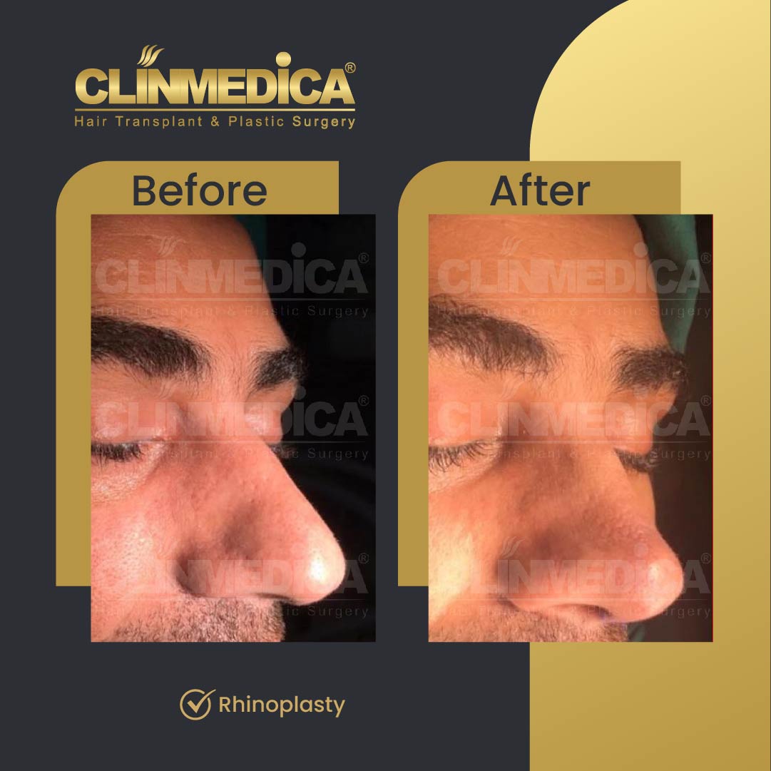 Rhinoplasty surgery in Turkey - before and after
