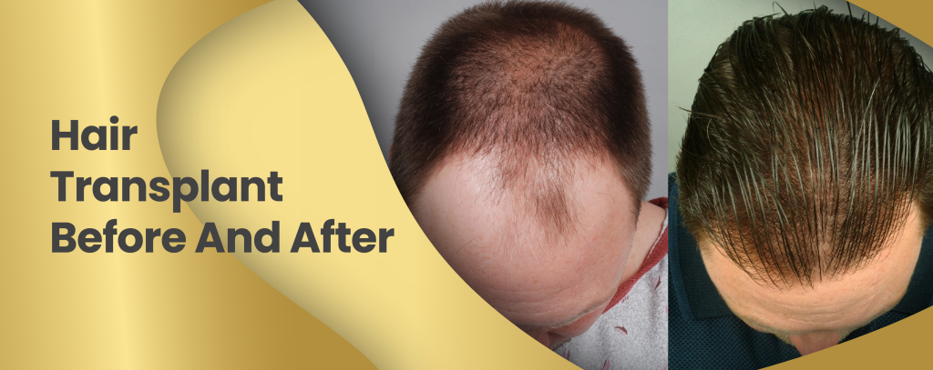 Hair Transplant Before and After Results - ClinMedica Turkey