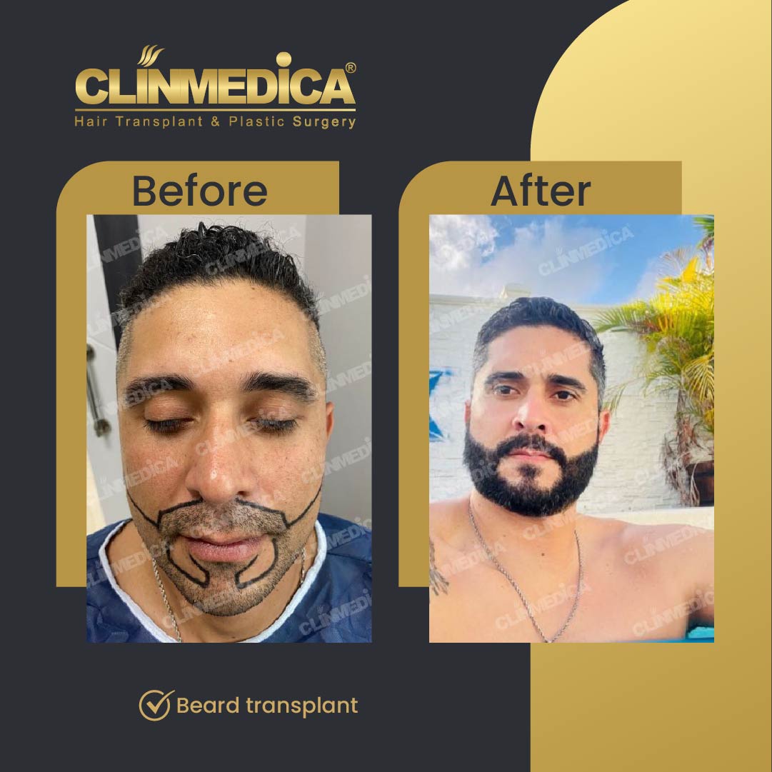 Beard transplant before and after results in Turkey