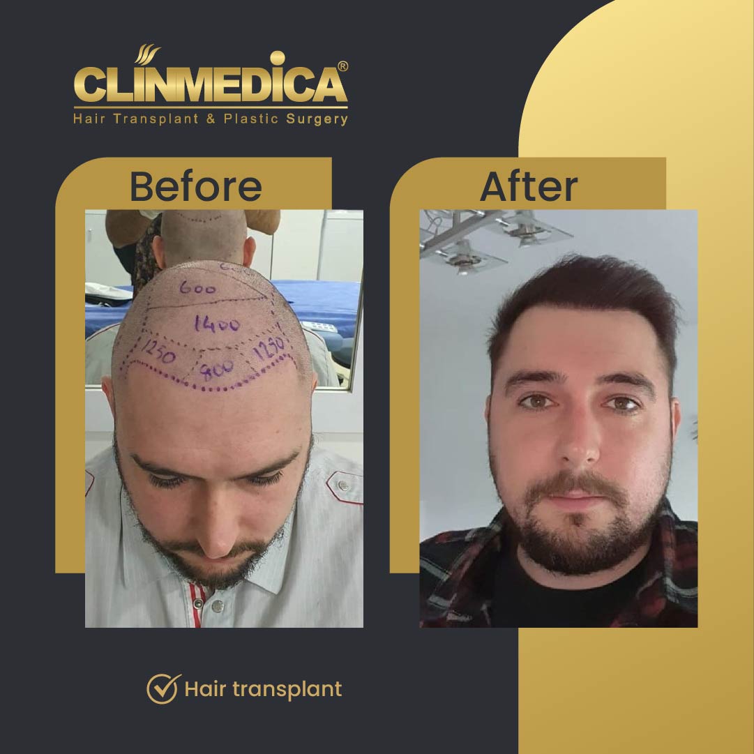Hair transplant before and after  results in Turkey