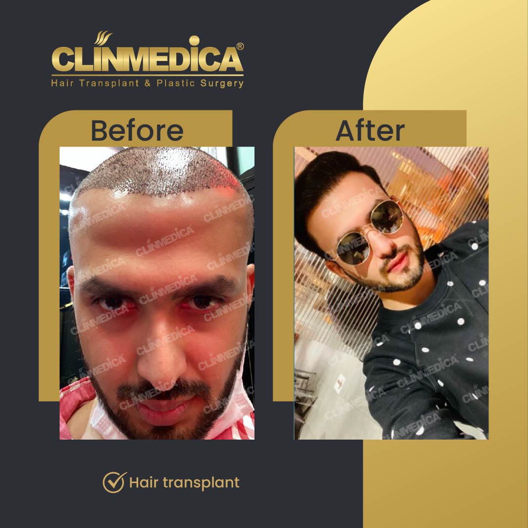 Hair transplant before and after  results in Turkey