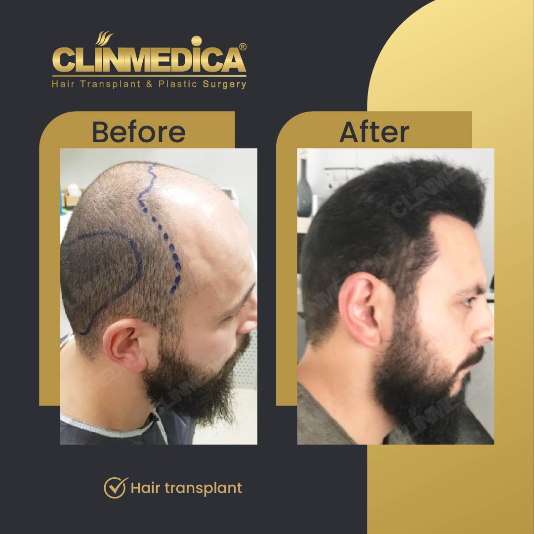 Hair transplant before and after results in Turkey
