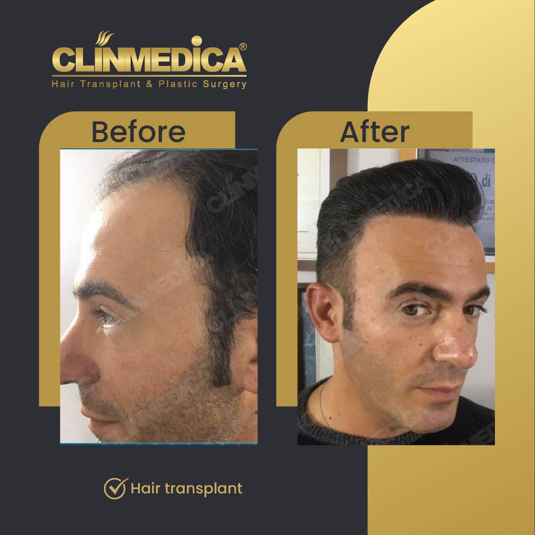 Hair transplant before and after results in Turkey