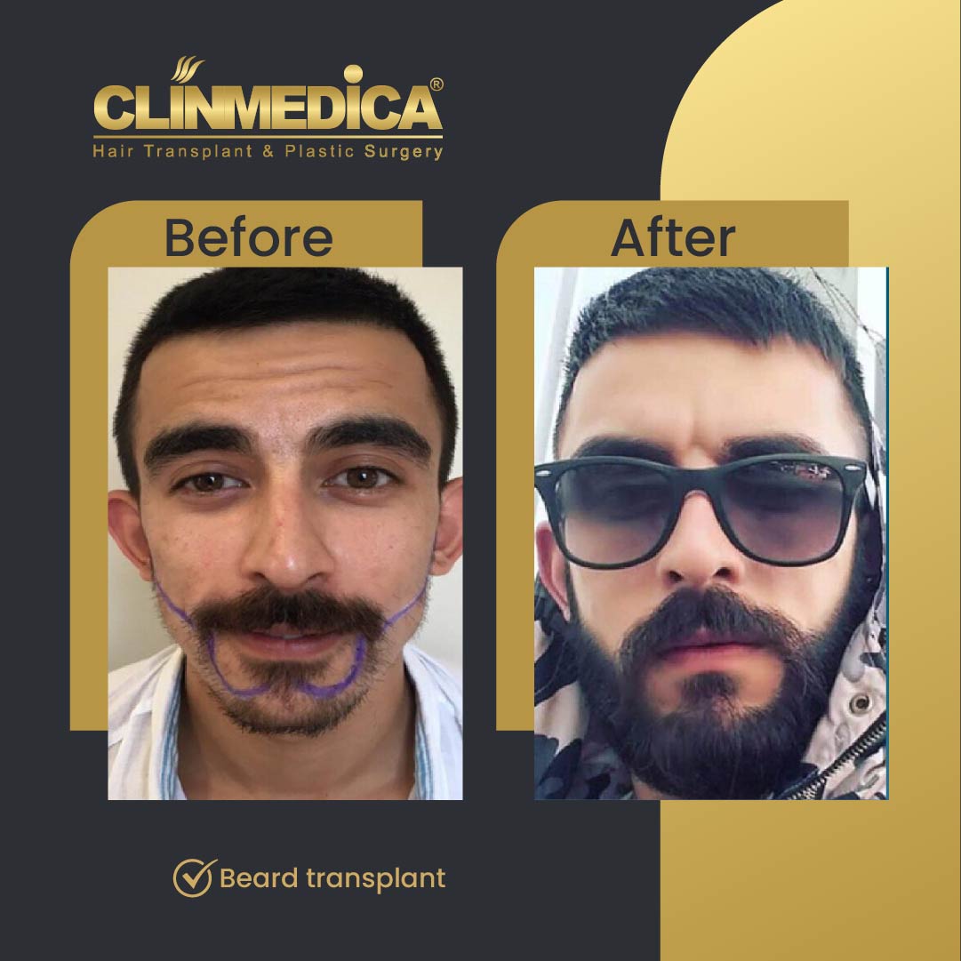 Beard transplant results before after in Turkey clinmedica