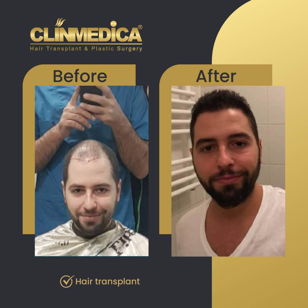 Dhi hair transplant results before after in Turkey clinmedicaDhi hair transplant results before after in Turkey clinmedica