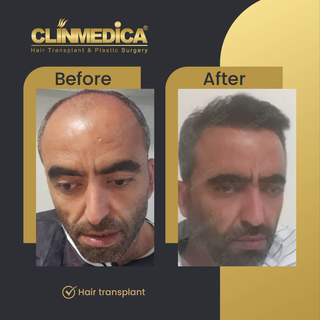 Dhi hair transplant results before after in Turkey clinmedica