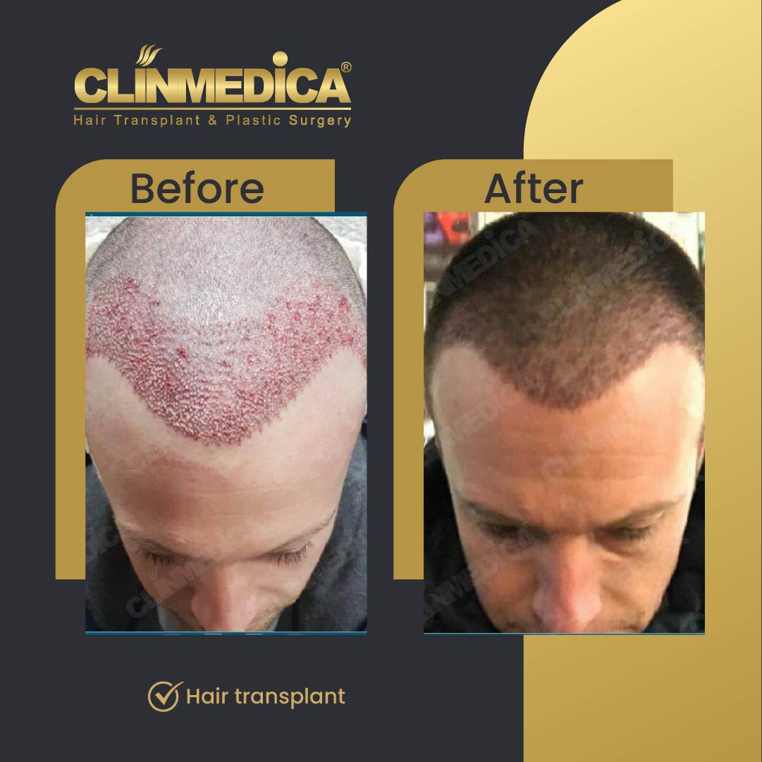 Dhi hair transplant results before after in Turkey clinmedica