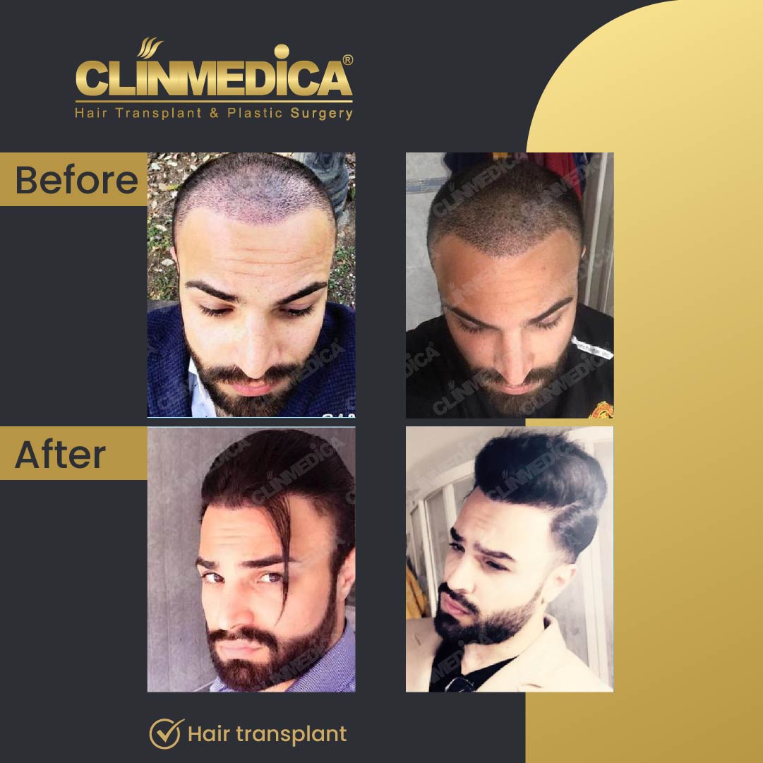 Dhi hair transplant results before after in turkey clinmedica