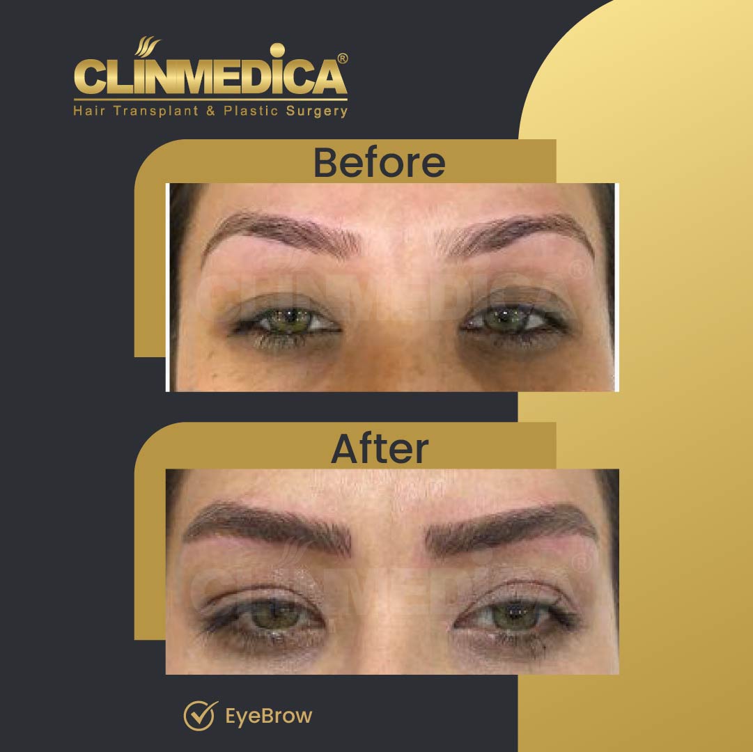 EyeBrow transplant results before after in turkey clinmedica