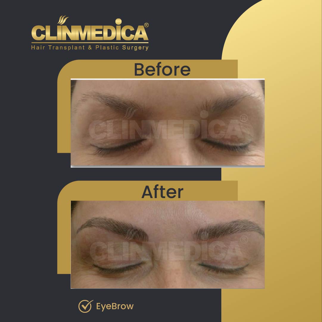 EyeBrow transplant results before after in turkey clinmedica