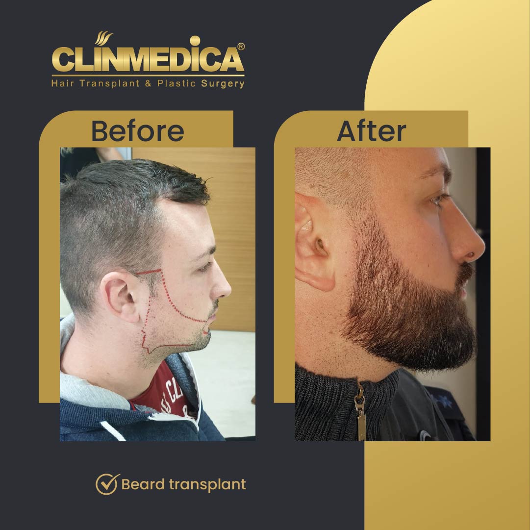 Fue Sapphire pen beard transplant results before after in turkey clinmedica3