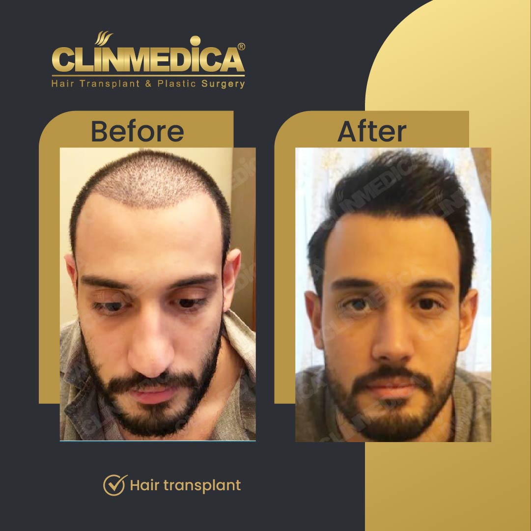 Fue Sapphire pen hair transplant results before after in turkey clinmedica-01