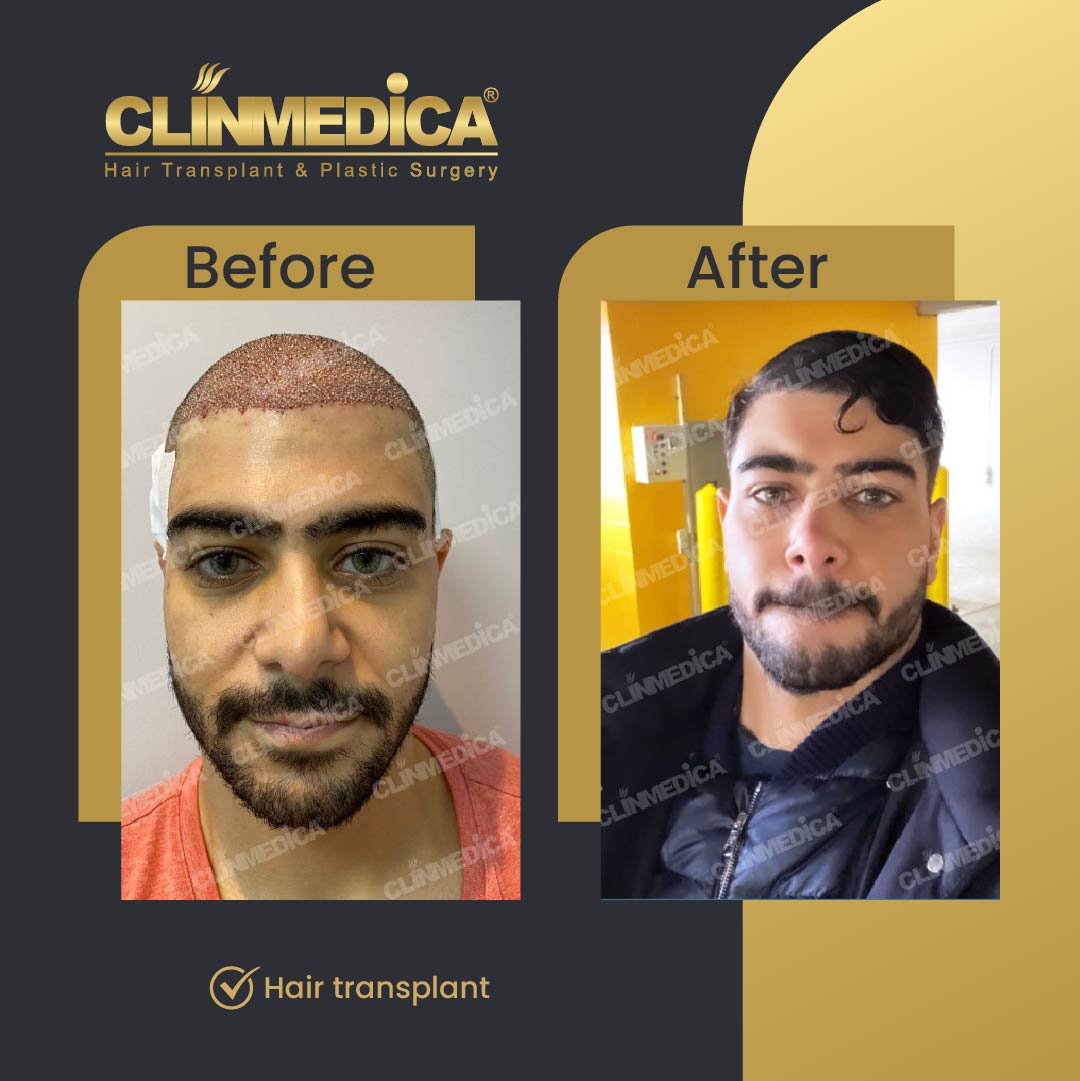 Fue Sapphire pen hair transplant results before after in turkey clinmedica-03