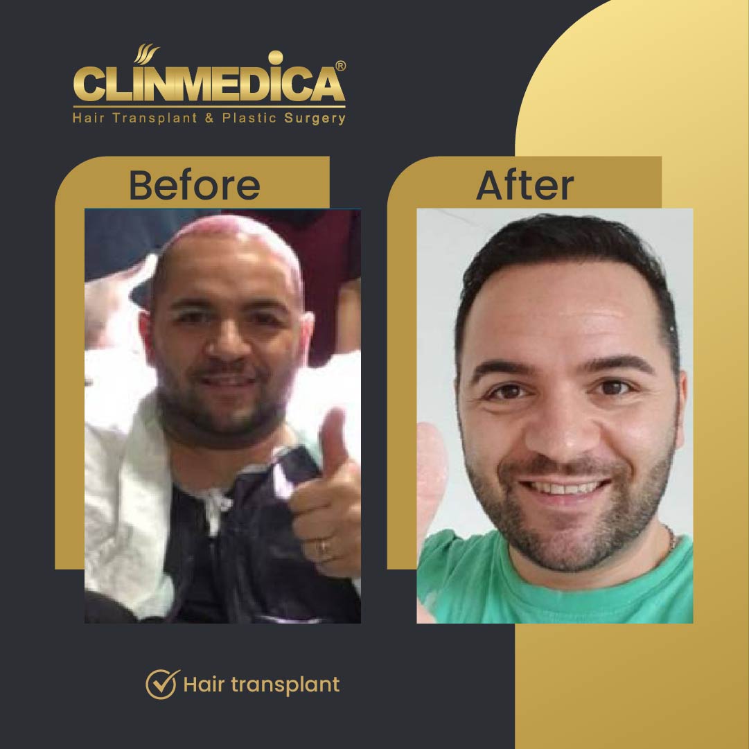 Fue Sapphire pen hair transplant results before after in turkey clinmedica-04