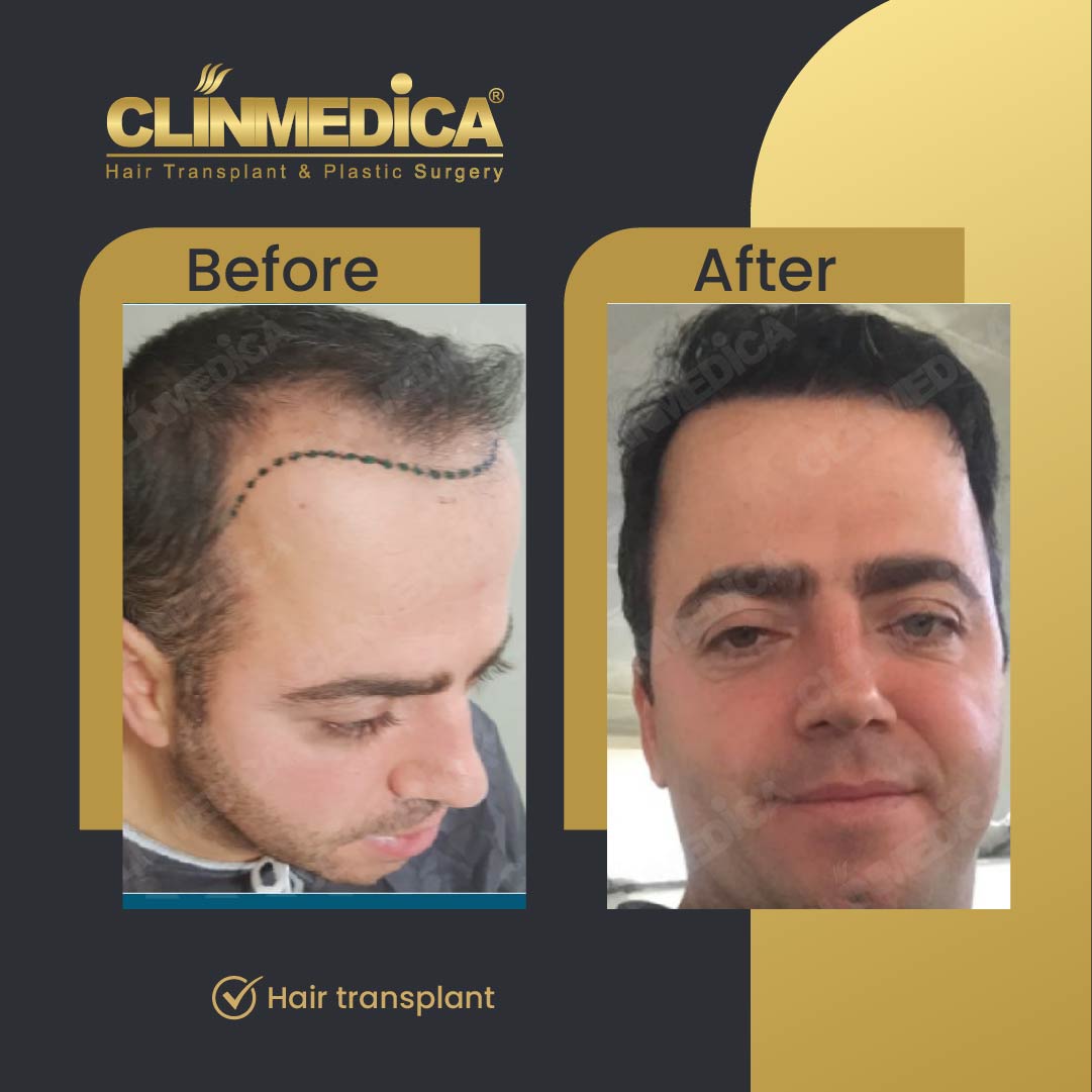 Fue Sapphire pen hair transplant results before after in turkey clinmedica-05