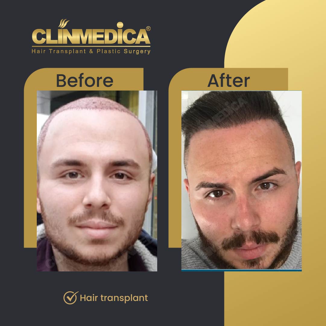 Fue Sapphire pen hair transplant results before after in turkey clinmedica-07