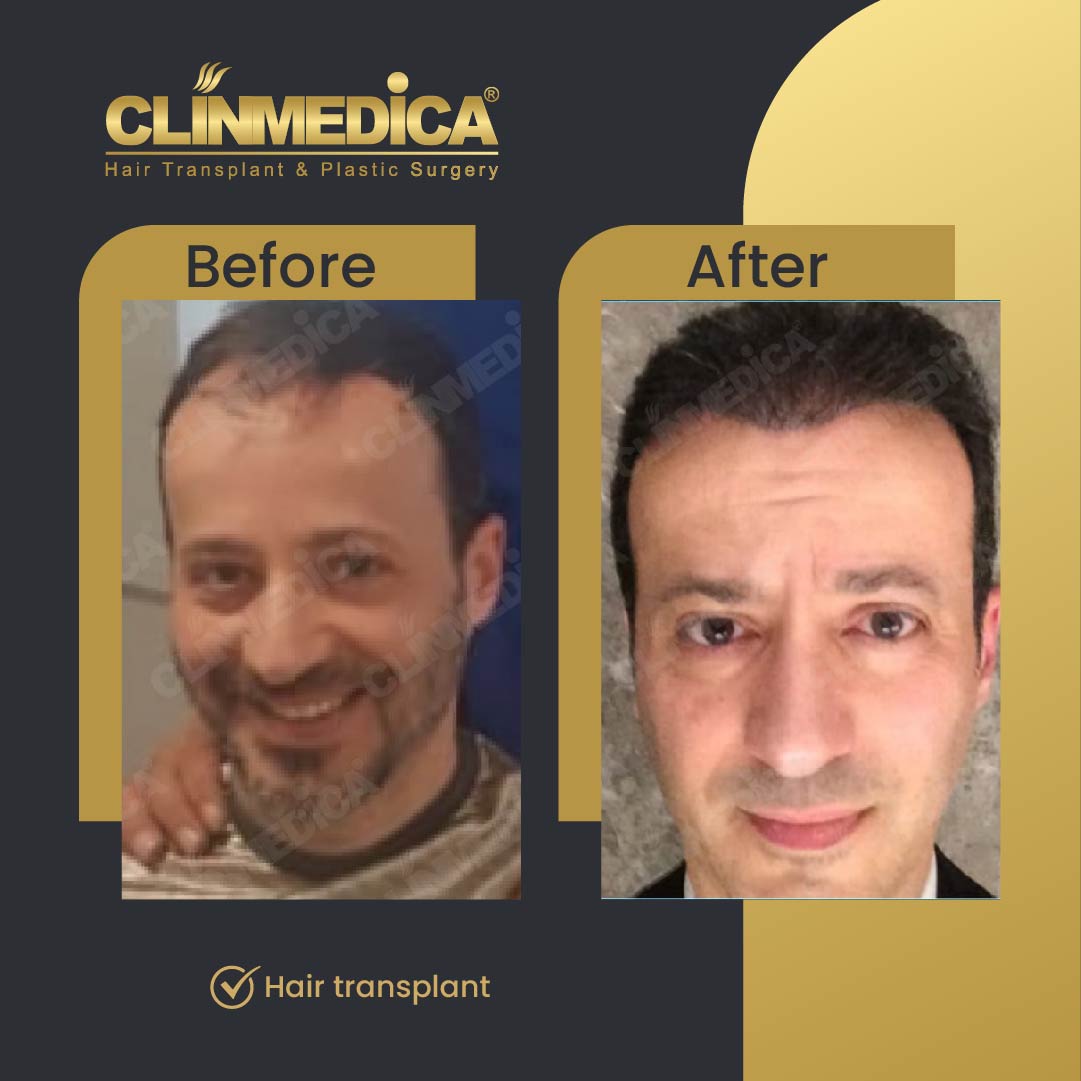 Fue Sapphire pen hair transplant results before after in turkey clinmedica-08