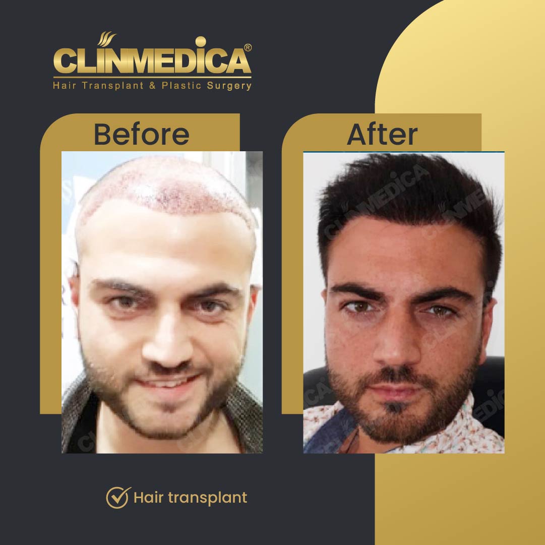 Fue Sapphire pen hair transplant results before after in turkey clinmedica-10