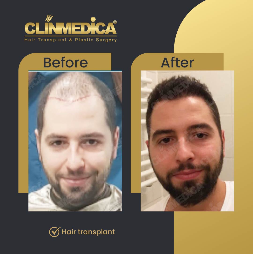 Fue Sapphire pen hair transplant results before after in turkey clinmedica