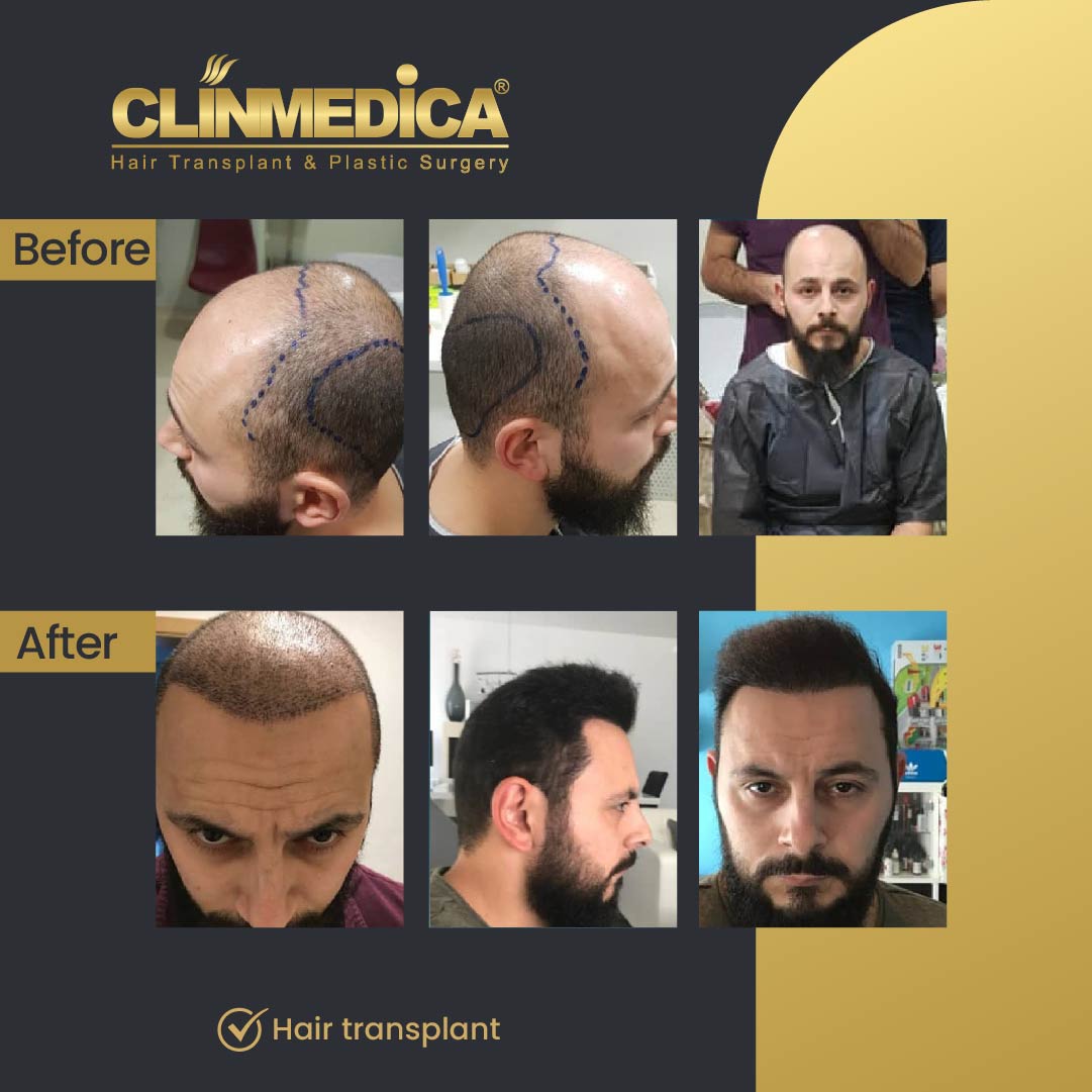 Fue Sapphire pen hair transplant results before after in turkey clinmedica-12