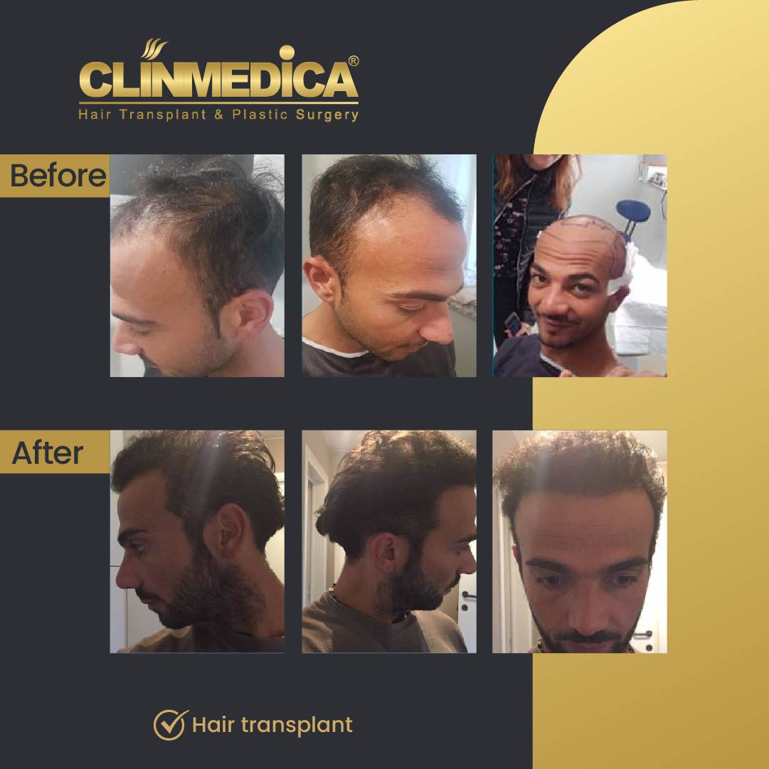 Fue Sapphire pen hair transplant results before after in turkey clinmedica-13