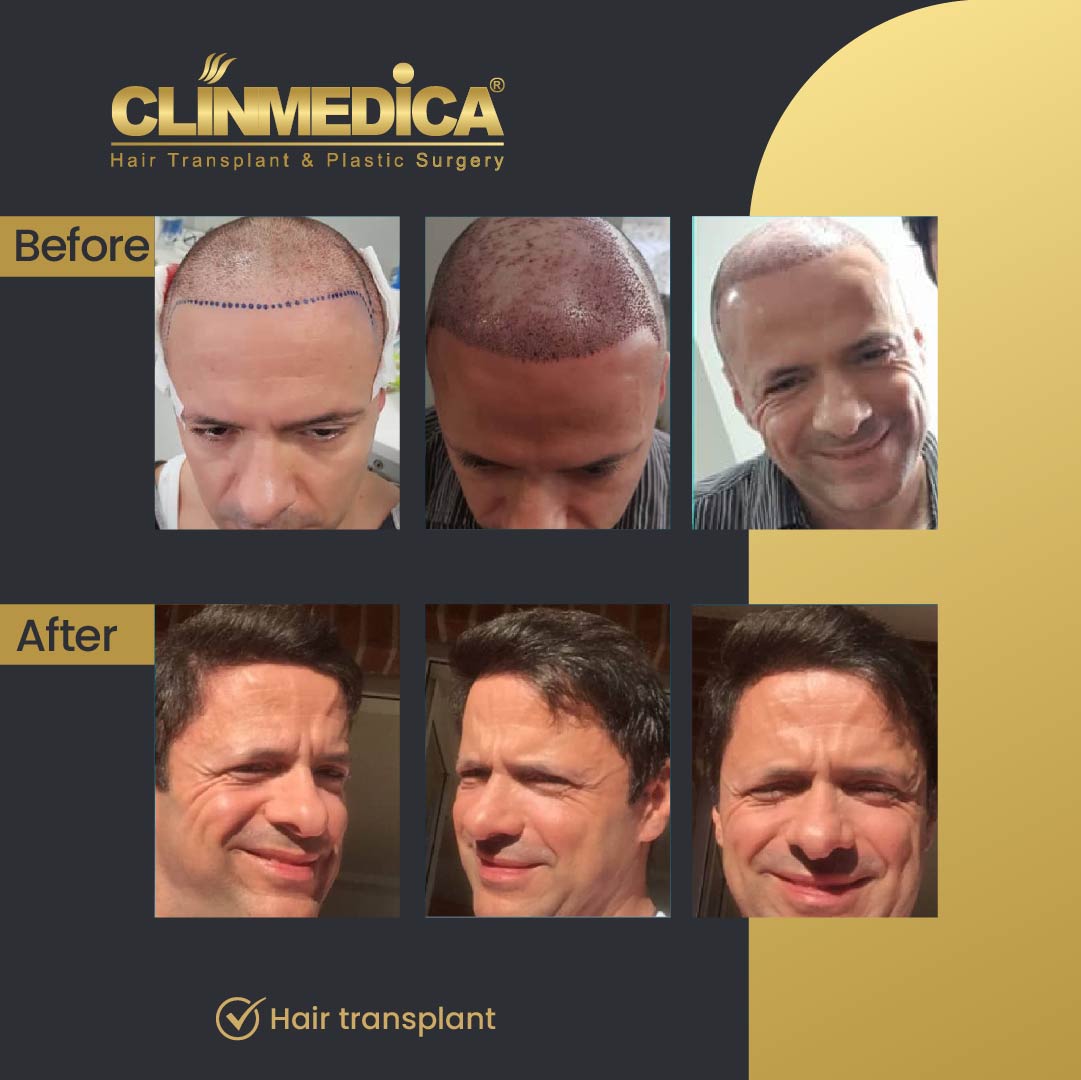 Fue Sapphire pen hair transplant results before after in turkey clinmedica-17