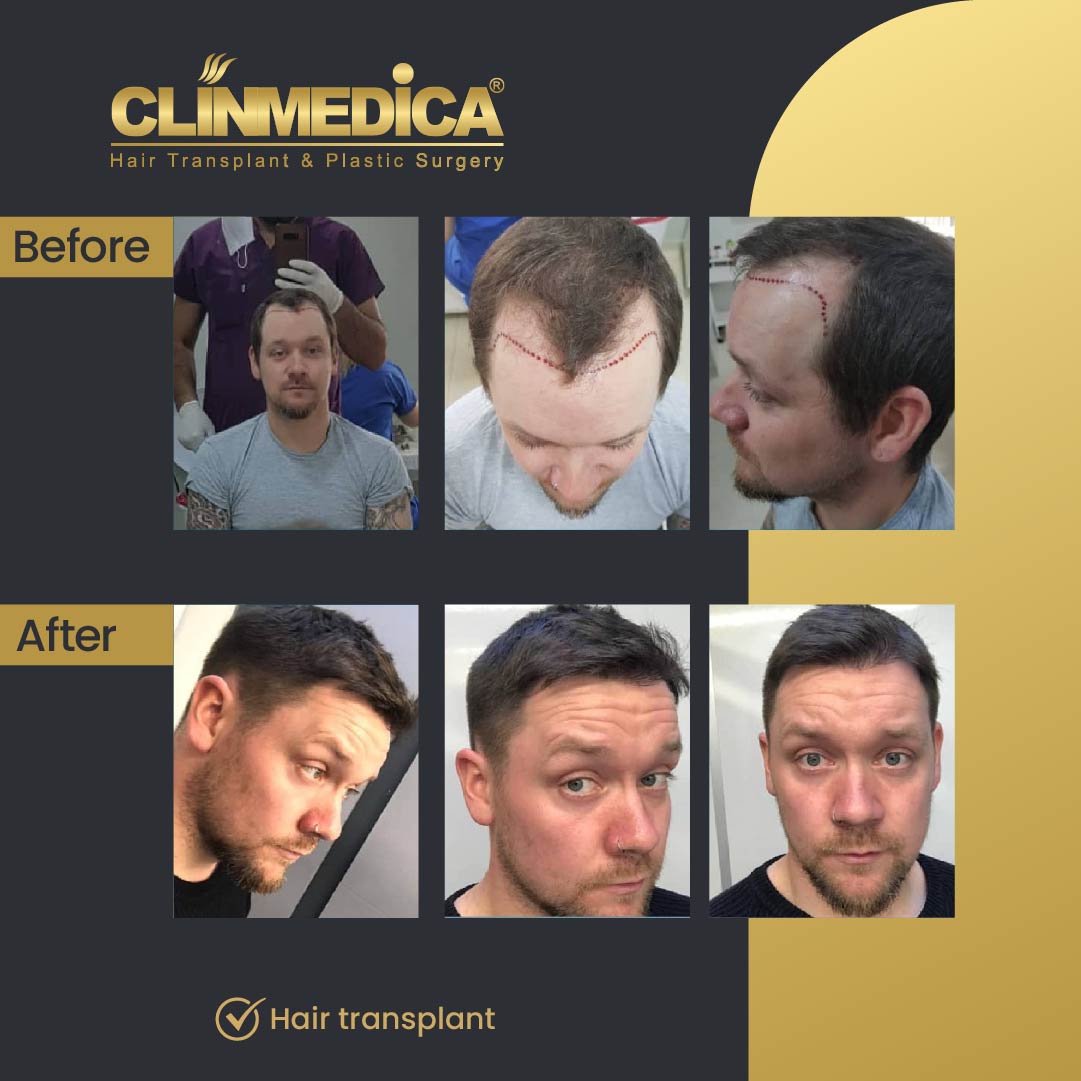 Fue Sapphire pen hair transplant results before after in turkey clinmedica
