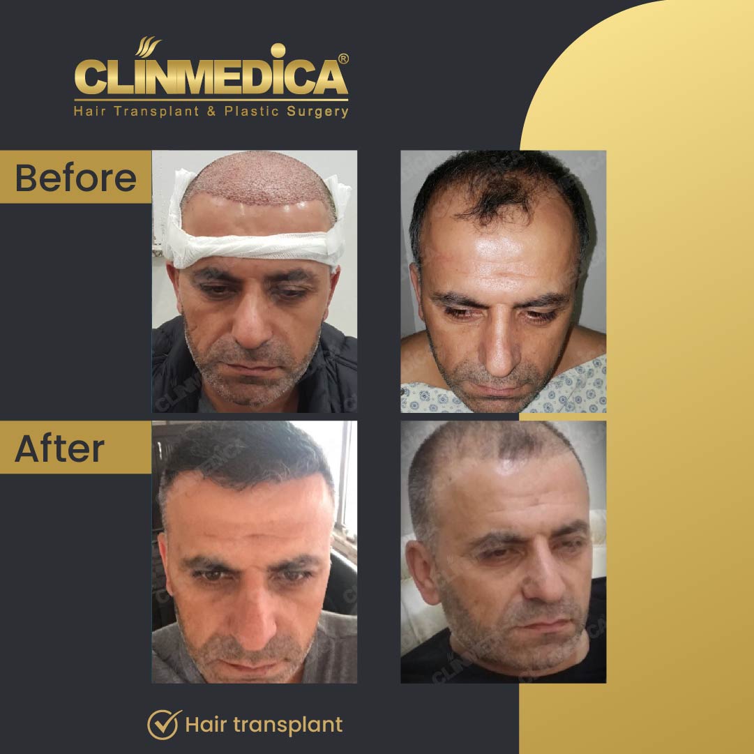 Fue Sapphire pen hair transplant results before after in turkey clinmedica-28