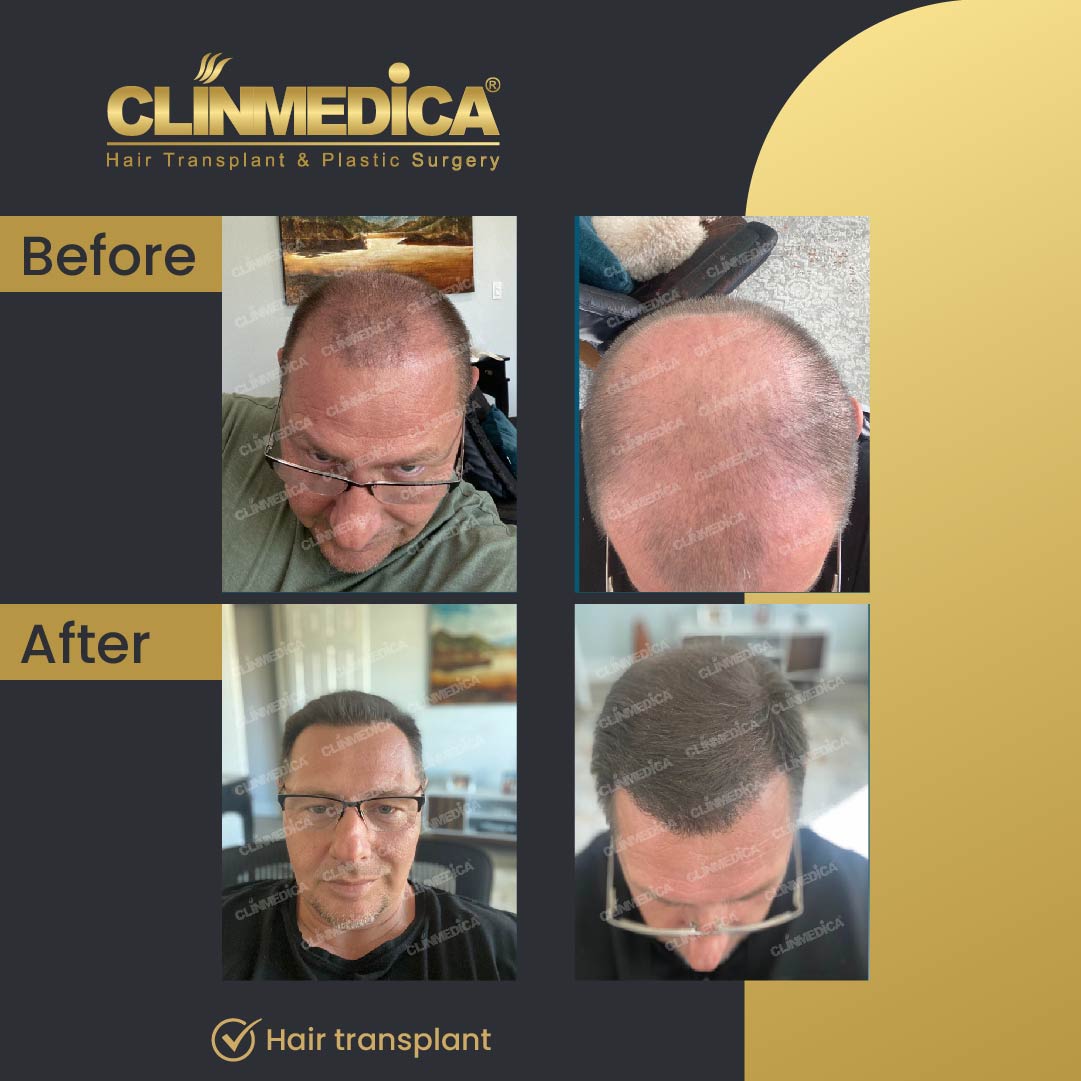 Fue Sapphire pen hair transplant results before after in turkey clinmedica-33