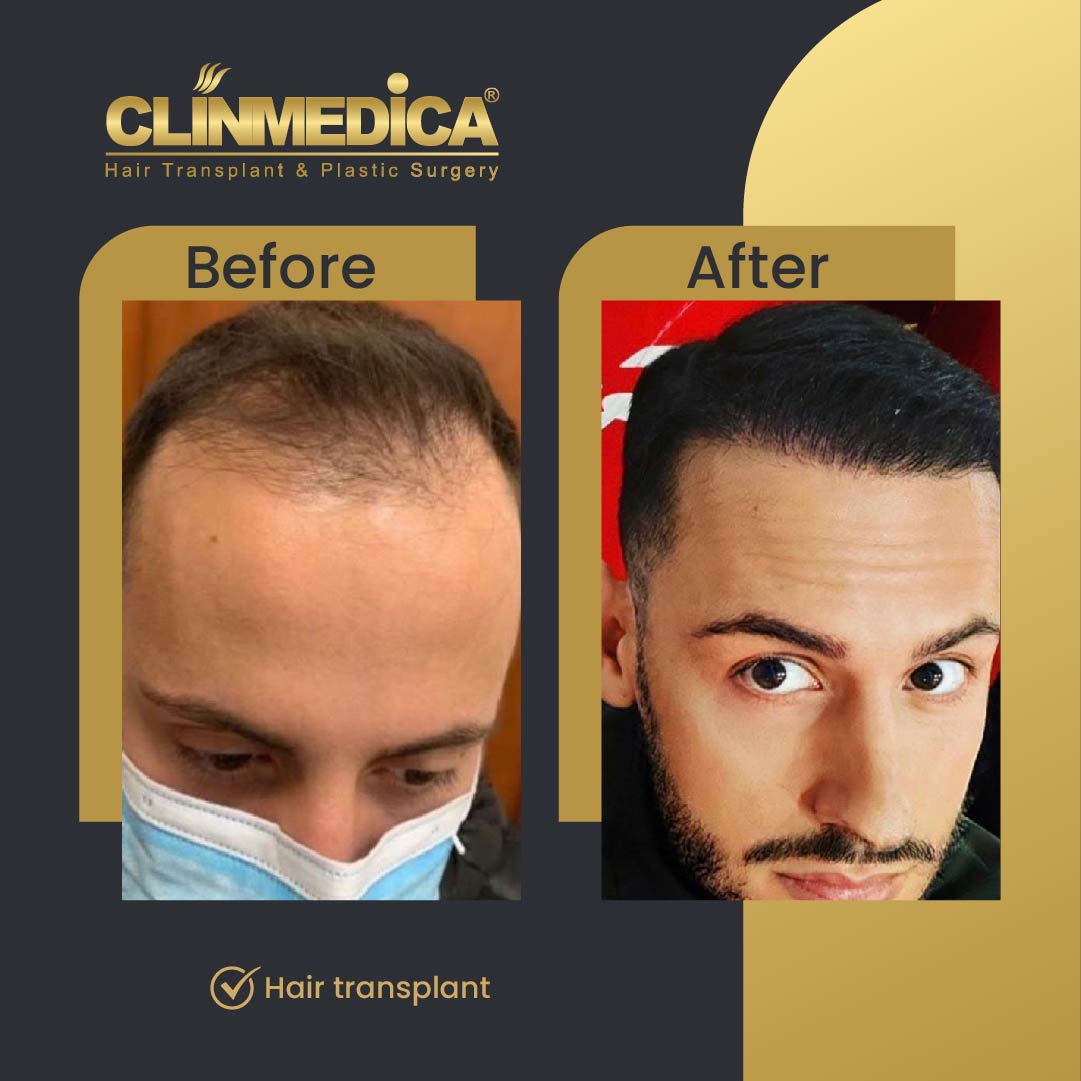 Fue hair transplant results before after in turkey clinmedica