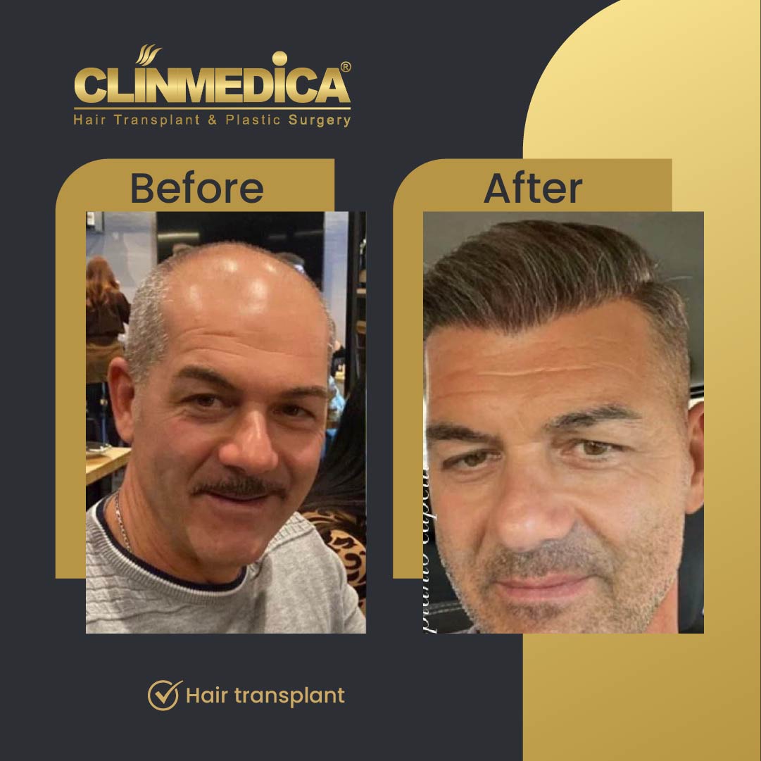Fue hair transplant results before after in turkey clinmedica