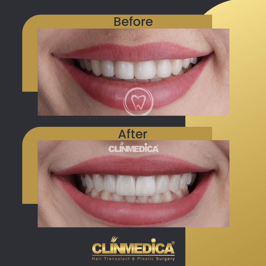 Dental Cosmetics in Turkey before and after