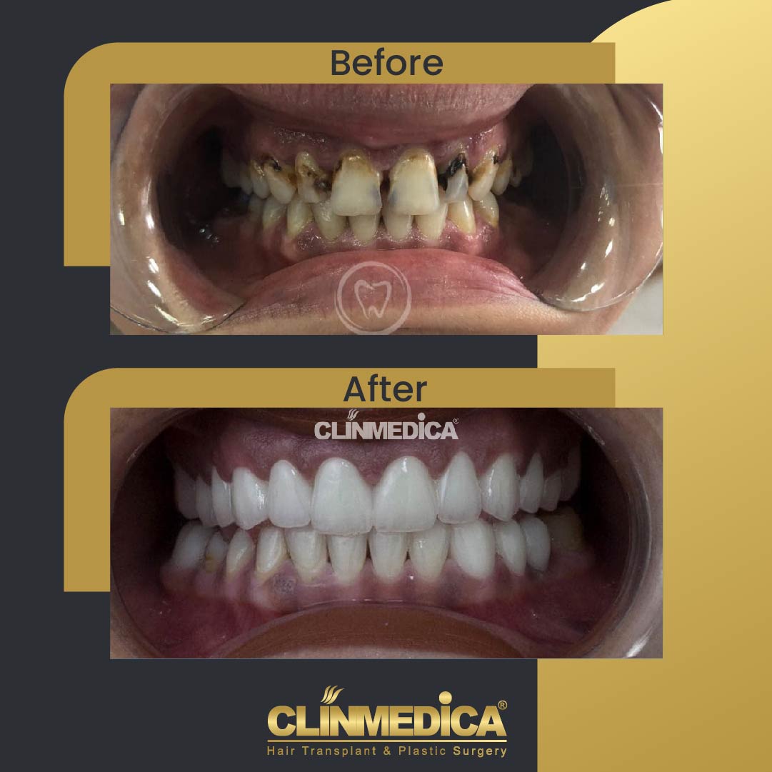 Dental Cosmetics in Turkey before and after