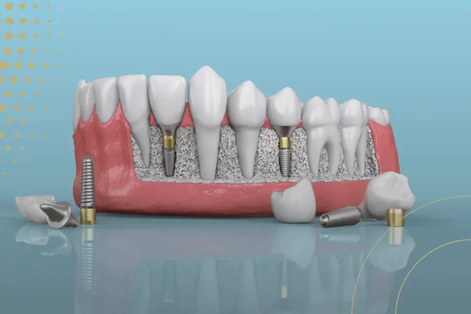 A Guide to Dental Implants in Turkey