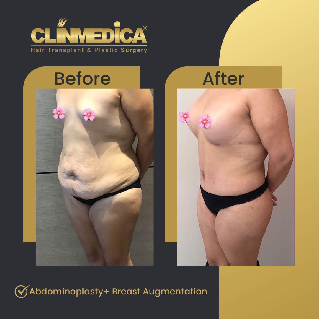 Mommy makeover, tummy tuck and abdominoplasty before and after in Turkey