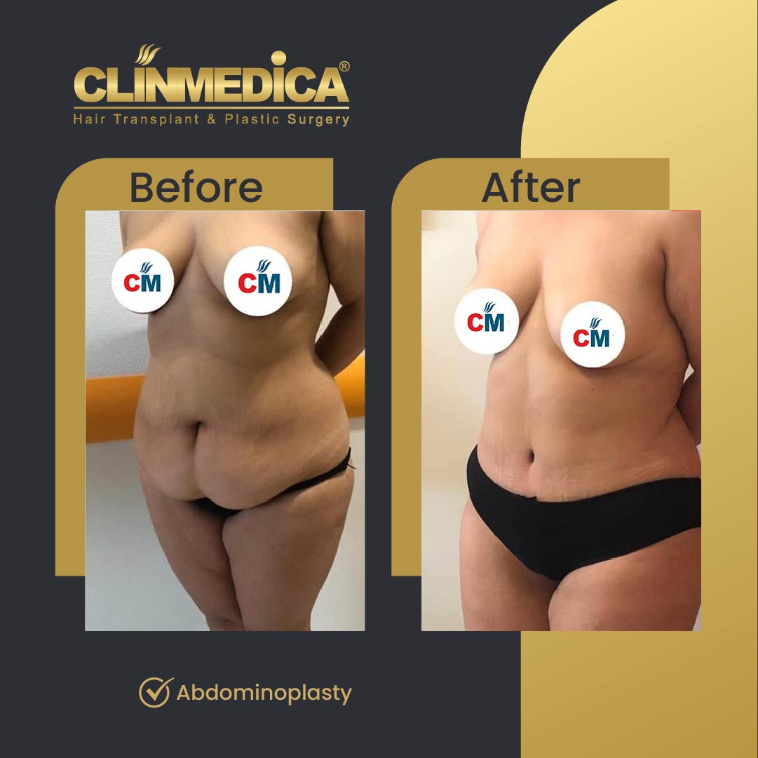 Mommy makeover, tummy tuck and abdominoplasty before and after in Turkey
