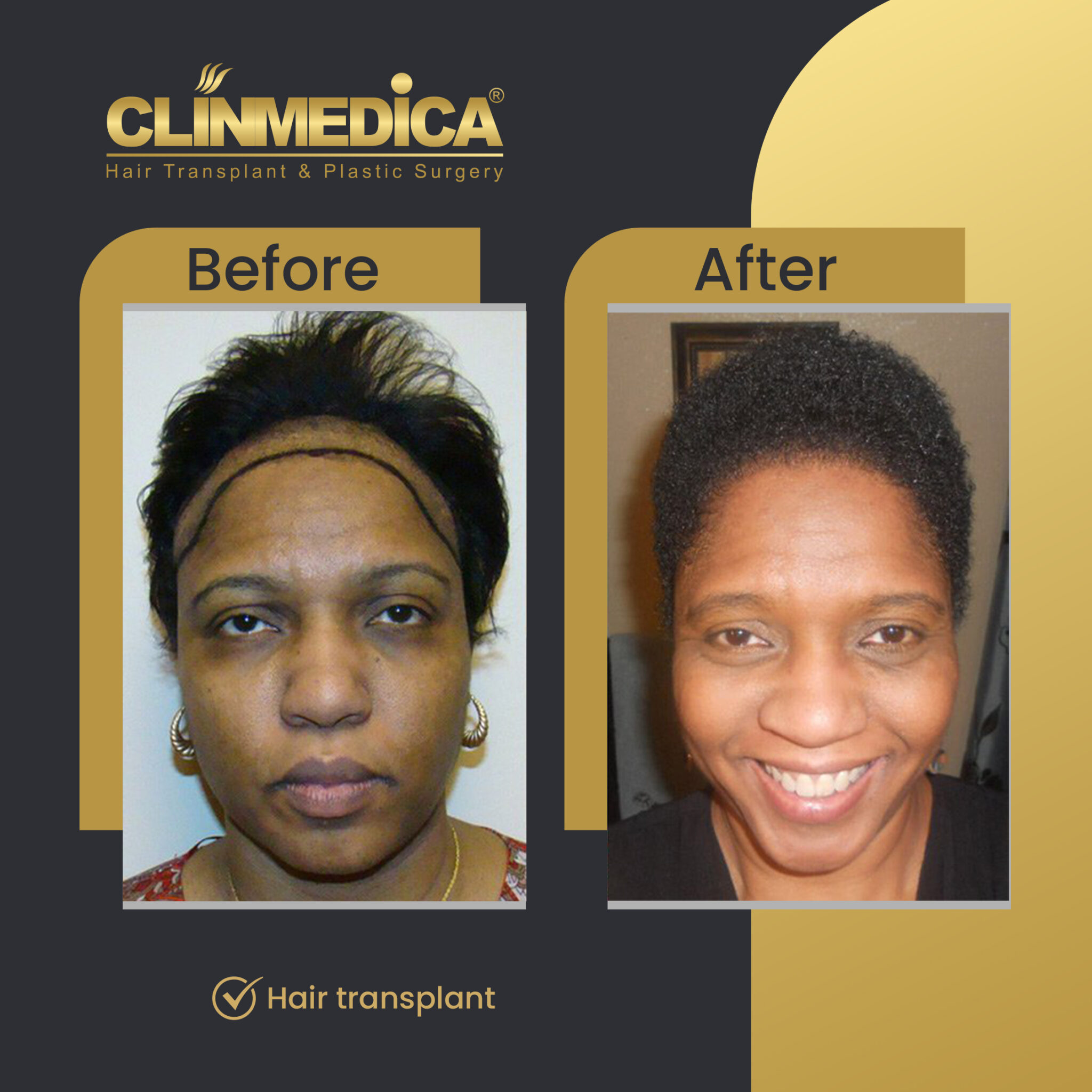 Afro-Hair-Transplant-for-women-Before-&-After-clinmedica-08