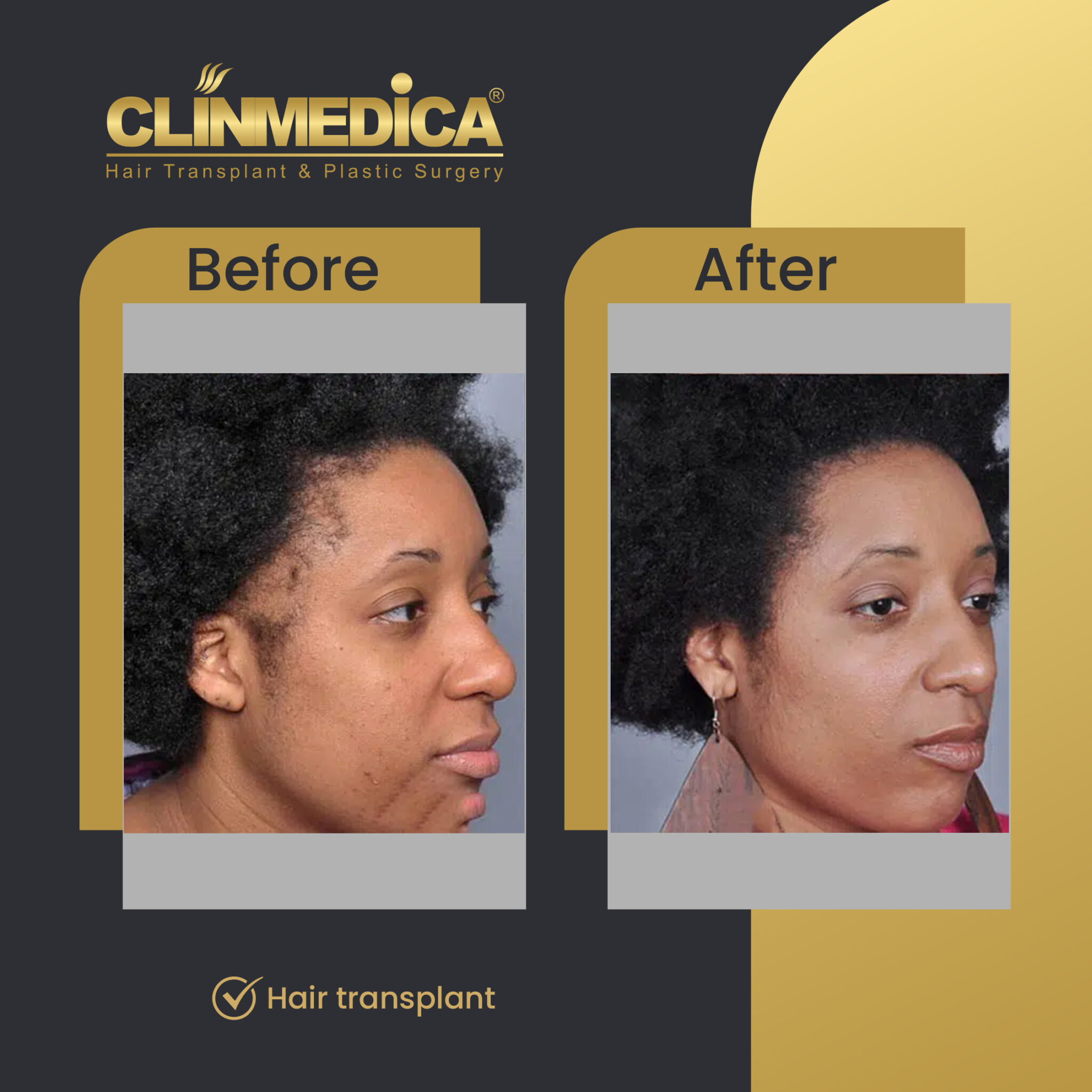 Afro-Hair-Transplant-for-women-Before-&-After-clinmedica-09