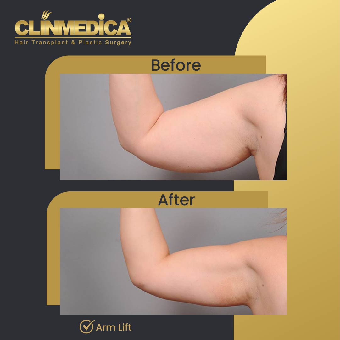 Arm Lift Before and After in Turkey