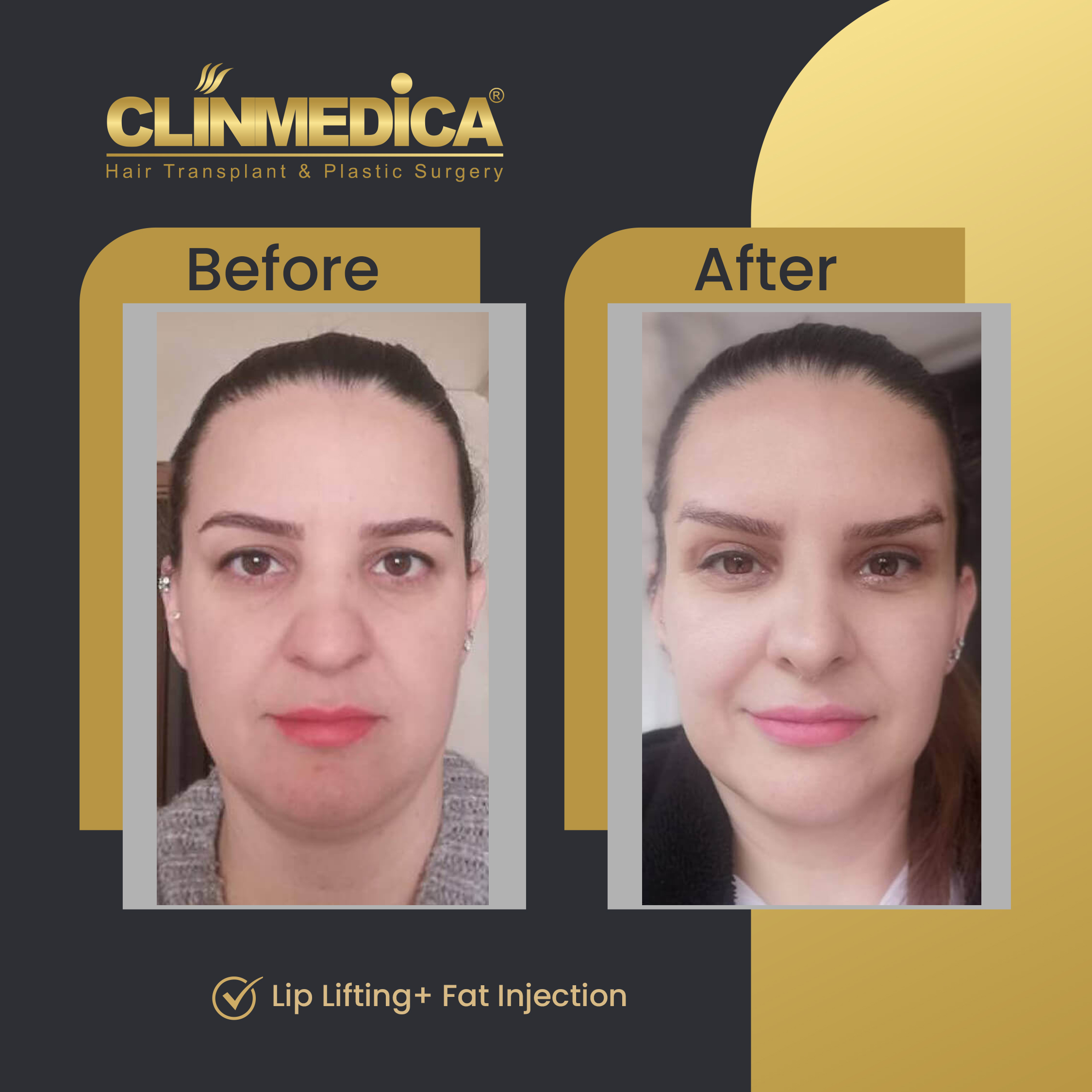 Lip Lifting & Fat Injection Before and After Results in Turkey