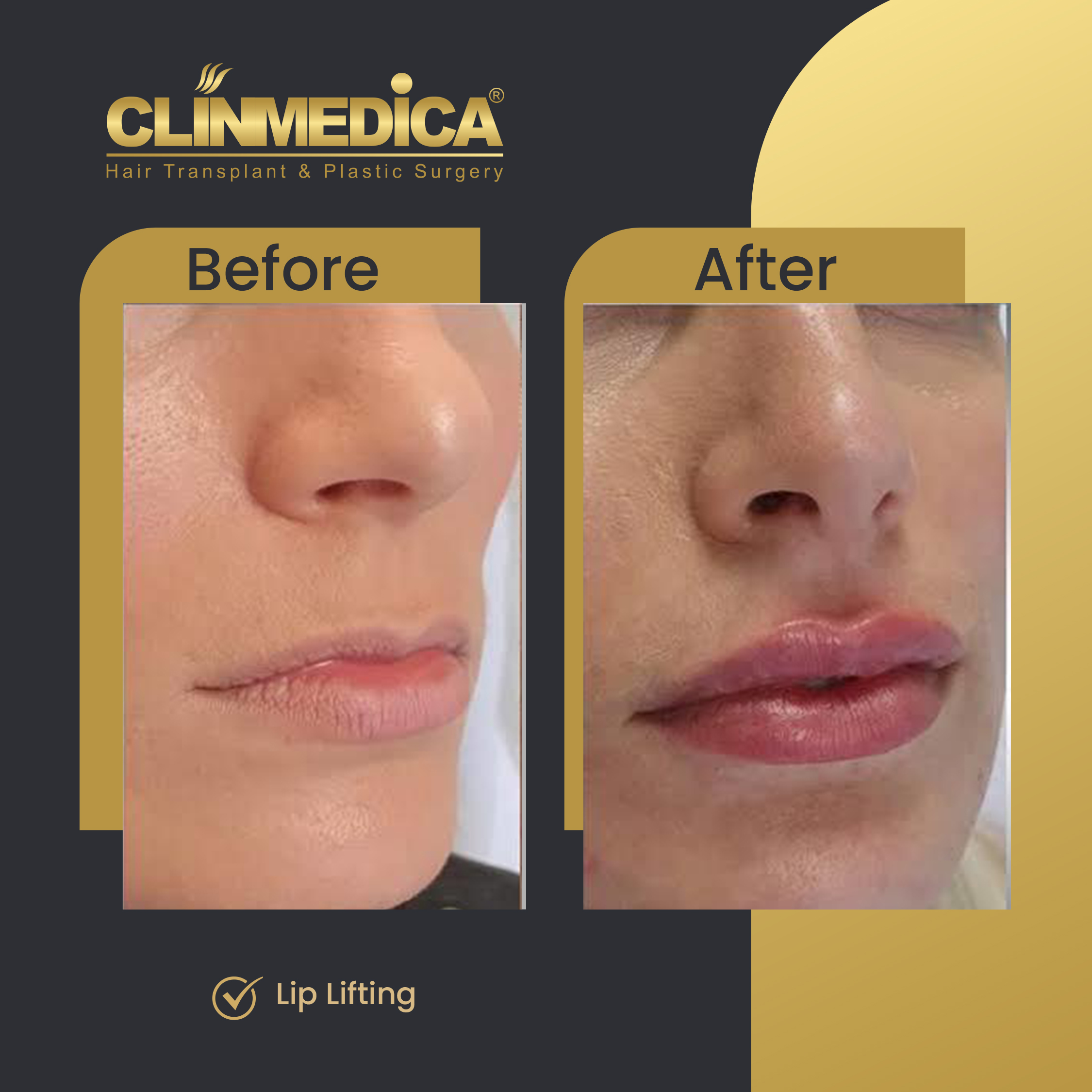 Lip Lifting before and after in Turkey