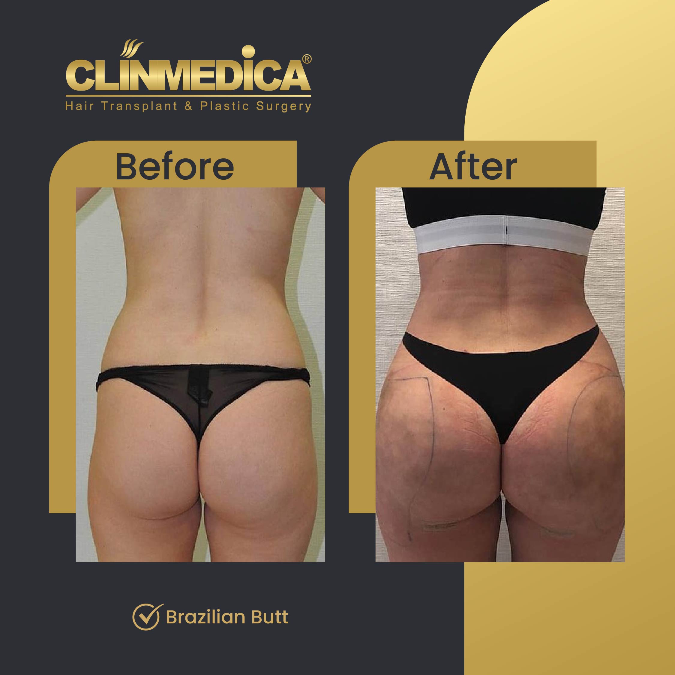 Brazilian Butt surgery in Turkey - before and after