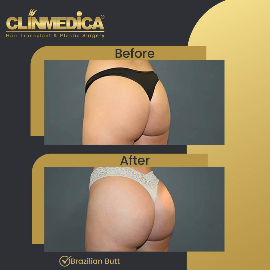 Brazilian Butt BBL before and after in Turkey