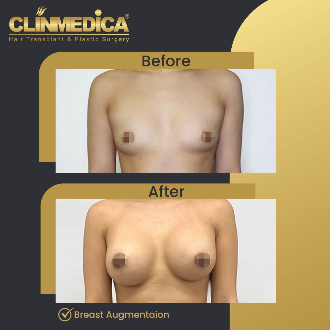Breast Augmentation before and After Turkey