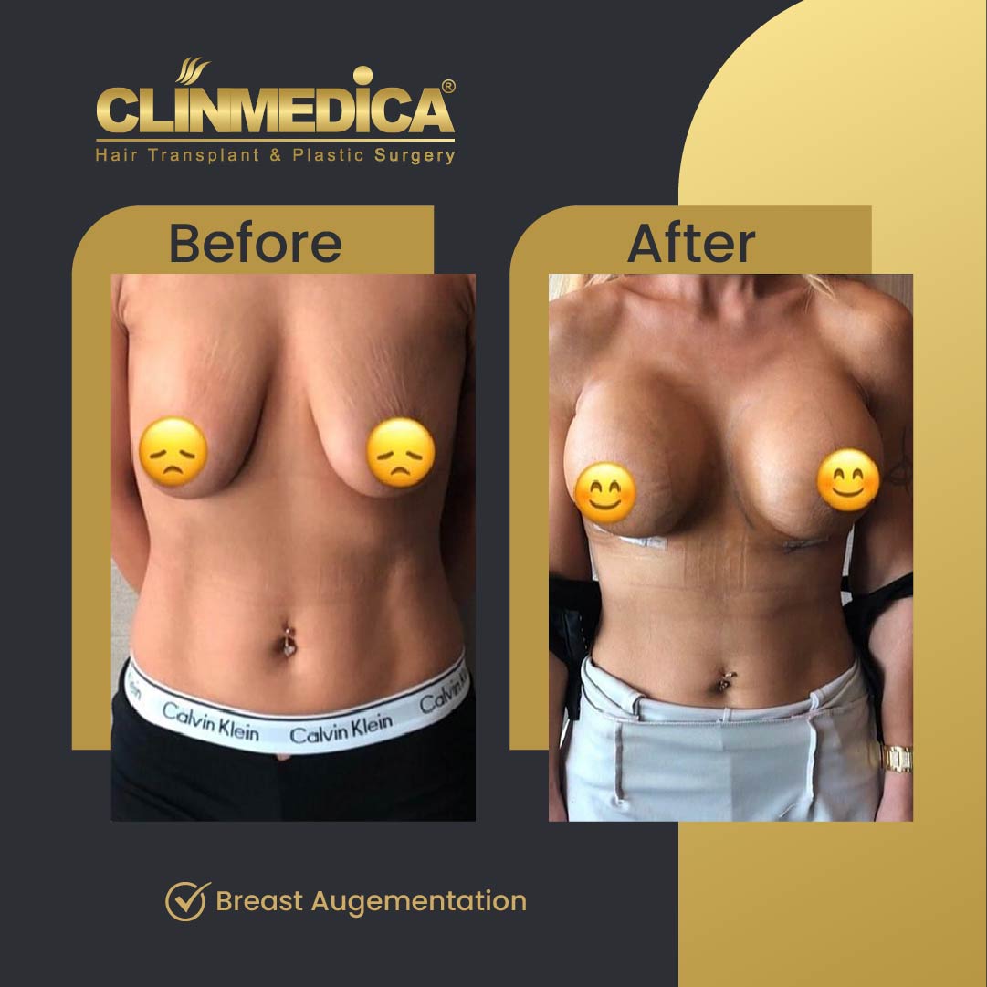 Breast Augmentation before and After Turkey